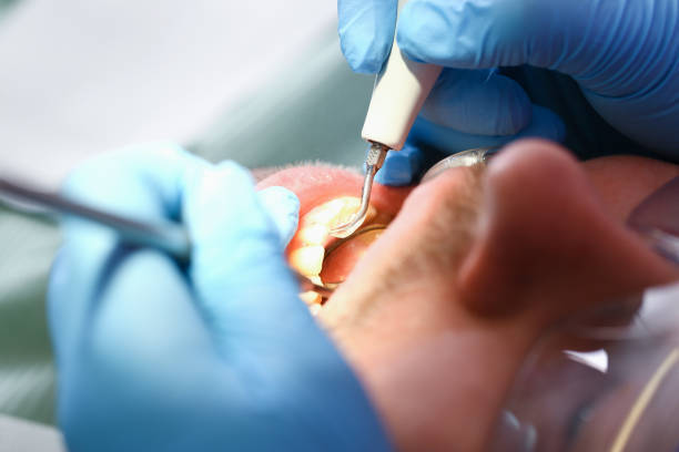 Best Emergency Treatment for Dental Infections or Abscesses in Kingston, RI