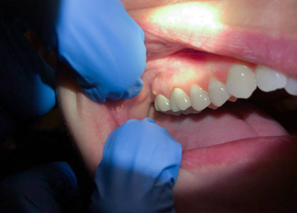 Best Emergency Treatment for Dental Infections or Abscesses in Kingston, RI